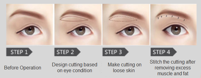 ptosis correction