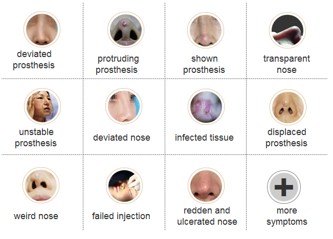 rhinoplasty revision