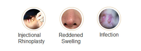 rhinoplasty revision