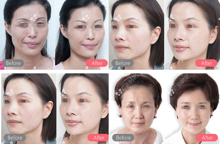 eye anti-aging