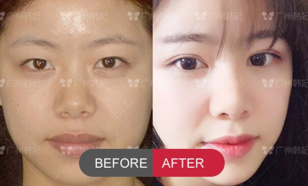 double eyelids surgery and rhinoplasty