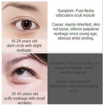 eye aging