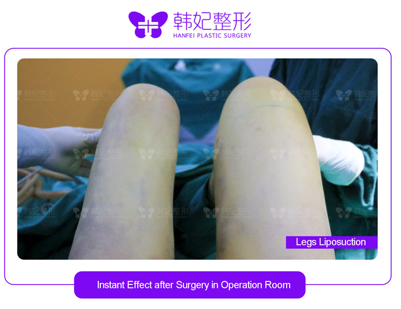 hanfei liposuction in china, face,neck,waist,abdomen,back,arms, legs cost 5000-20000rmb