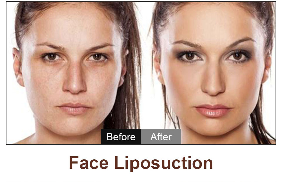 face liposuction