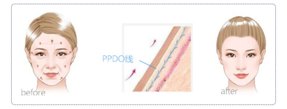 ppdo thread face lift before and after